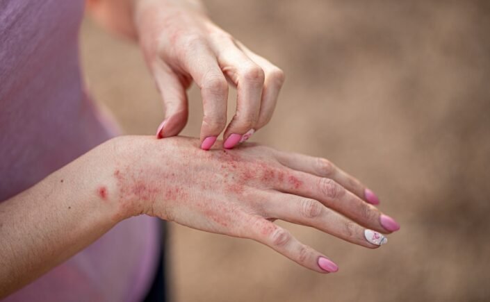mulher coçando a mão com manchas vermelhas na pele, sinais de dermatite